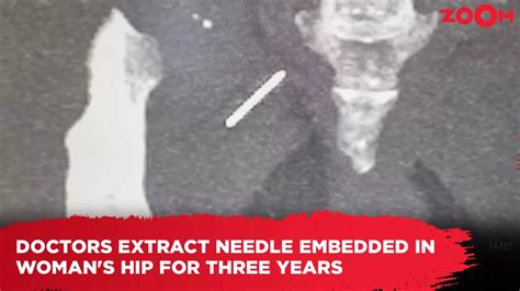 Decades of Pain: Nurse Yana DeGragoris Exposes Medical Error That Left Needle Embedded for 7 Years